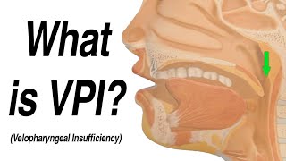 Velopharyngeal Insufficiency VPI Causing Hypernasal Speech and Nasal Regurgitation with Swallow [upl. by Lareine]