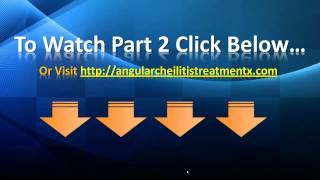 Angular Cheilitis Treatment  Angular Cheilitis Home Remedies [upl. by Aehtna792]