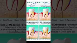 STAGES OF GUM DISEASES dental dentist dentistrystudent chatgpt [upl. by Acimat561]