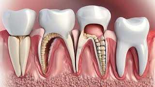 Understanding Periodontal Disease  What Are the Symptoms and Treatment Options [upl. by Aligna767]