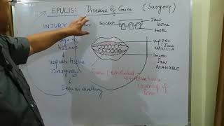 Surgery topic EPULIS part 1 [upl. by Steinberg]