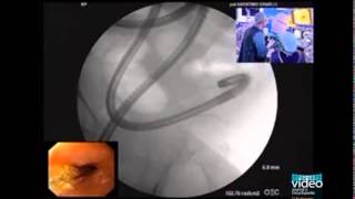 Enteroscopic Balloon Dilation of Multiple Ileal Strictures in Suspected Crohns Disease [upl. by Fia656]