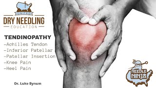 Tendinitis and Tendinopathy Dry Needling Treatment Protocol [upl. by Piper458]