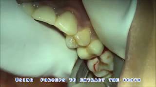 Extraction of upper 1st molar using forceps [upl. by Bolitho]