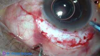 Management of an IOL drop into vitreous cavity after YAG Laser  Pradip Mohanta 16 Oct 2020 [upl. by Constantia]