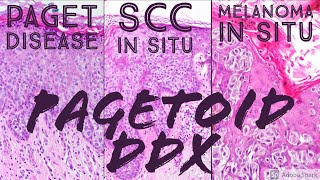 Pagetoid Differential Paget disease vs Melanoma in situ vs Squamous cell carcinoma in situ Bowen [upl. by Bowne]