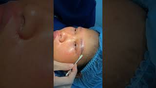 wenkbroue lig laer ooglid chirurgie krimp die philtrum xuhuongyoutube lamdep thongthainguyen [upl. by Kutzenco]