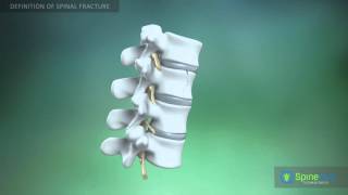 Spinal fractures Definition [upl. by Hess]