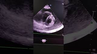 Massive Pericardial EffusionSwinging Heart Sign Clinical Pearl4 [upl. by Omolhs]