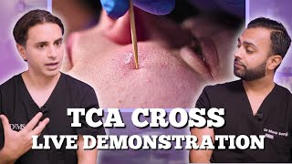 TCA Cross For Acne Live Demonstration  TCA Cross Aftercare Advice  Dr Somji amp Solomon Discuss [upl. by Dogs]