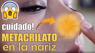 Retiro de METACRILATO de la NARIZ 👃🏼 RINOPLASTÍA 😱 Complicaciones del METACRIL 🤩 Dr ALBERTO CALVO [upl. by Leslee]