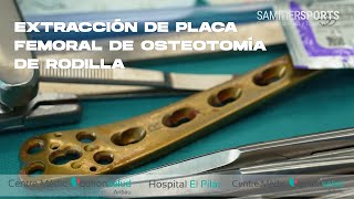 EXTRACCIÓN DE PLACA FEMORAL DE OSTEOTOMÍA DE RODILLA [upl. by Keppel663]