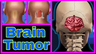 ASMR 🧠 brain tumor surgery animation video [upl. by Stich]