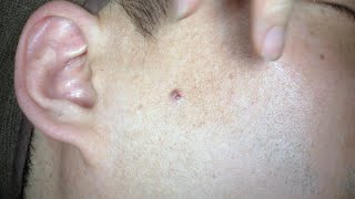 Pyogenic Granuloma Hemangioma on Face Removal Surgery HD 중년 남성의 얼굴에 생긴 화농성 육아종 혈관종 제거 수술 유디트 [upl. by Cade423]