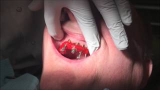 allonx allon4 StepbyStep AllonFour Dentures Part 1 Impressions [upl. by Anitnuahs649]