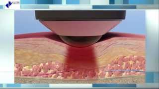 Deep Tissue Laser Therapy The Science Behind Healing [upl. by Nylhtak]