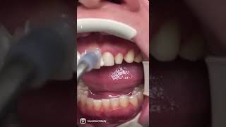 Minimal Prep Veneers just like that [upl. by Yerdna]