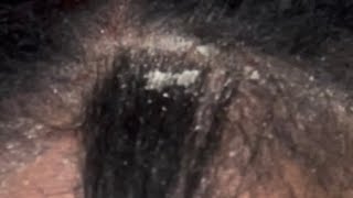 Dandruff Scratching Buildup Lots of Scaly Popping Psoriasis Flakes Itchy Scalp Flareup [upl. by Nivlek]