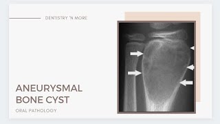 ANEURYSMAL BONE CYST [upl. by Ileane]