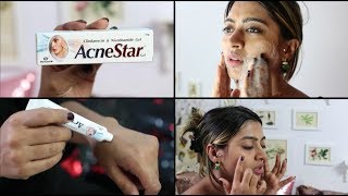 Acnestar Gel Review  HOW TO REALLY GET RID OF ACNE  SuperWowStyle Prachi [upl. by Flessel641]