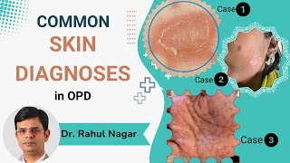 Common Skin Diagnoses In OPD [upl. by Eliseo32]