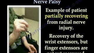 Radial Nerve Palsy Recovering  Part II Everything You Need To Know  Dr Nabil Ebraheim [upl. by Tdnerb]