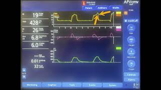 Delayed Cycling on Mechanical Ventilation [upl. by Enitsej]