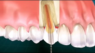 ¿Qué es la endodoncia y cómo se realiza Clínica Dental Más Bermejo Murcia [upl. by Maram489]