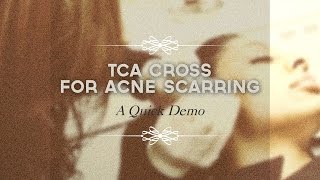 TCA CROSS for acne scarring [upl. by Jedlicka]