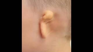 Microtia Awareness Day 👂🦻microtiaawarenessday speechandhearing hearingaids speechtherapy [upl. by Araed]