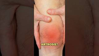 Artritis vs artrosis ¿ Cuáles son las diferencias artritis artrosis rodilla drwilsondelgado [upl. by Marlo992]