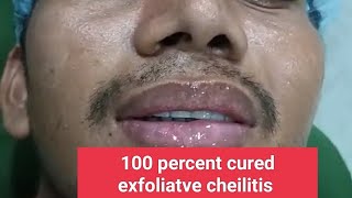 100 percent cured exfoliatve cheilitis treated by Laser and some medicines [upl. by Azelea]