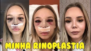 VLOG MINHA RINOPLASTIA PÓS OPERATÓRIO [upl. by Yznil]