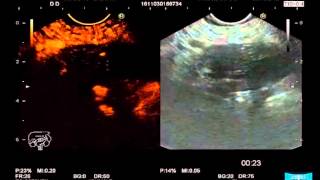 EUSGuided FineNeedle Aspiration for the Diagnosis amp Staging of Pancreatic Masses [upl. by Nna]