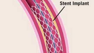 Angioplasty [upl. by Katzen584]