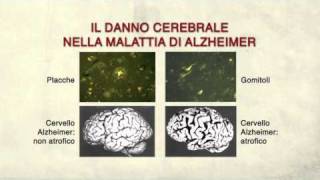 Cosa causa la malattia di Alzheimer  release 2 [upl. by Body]