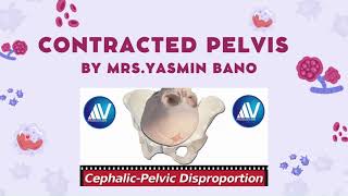 contracted pelvis and CPD [upl. by Nimzaj]