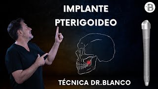 Implante pterigoideo ¿Cuándo y cómo lo utiliza el Dr Blanco [upl. by Leontine]