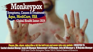 Monkeypox Virus Causes Symptoms Treatment and Prevention [upl. by Hteb954]