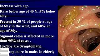 diverticular disease of sigmoid [upl. by Meta]