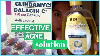 DALACIN C FOR ACNE DARK SPOTS  HIGHLY EFFECTIVE ACNEPIMPLE SOLUTION  Helmz Jordan [upl. by Schumer]