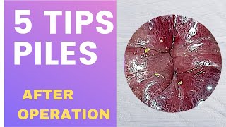 5 BEST TIPS  AFTER PILES OPERATION  BAWASIR [upl. by Oap]