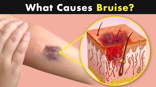 Bruises  Why does it happens  Symptoms Causes and treatment UrduHindi [upl. by Aristotle]