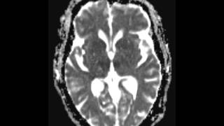 Basilar Tip Thrombosis top of the basilar syndrome [upl. by Ynettirb]