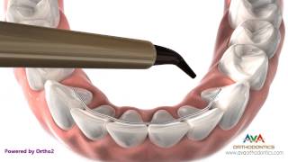 Orthodontics Retainer  Bonded or Permanent [upl. by Nwahsram]