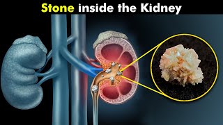 How Kidney Stones Are Formed UrduHindi [upl. by Acirederf223]