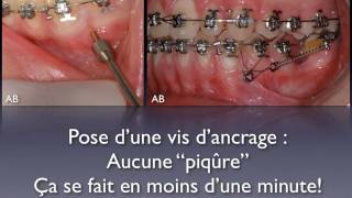 Minivis dancrage en orthodontie orthoLemaycommov [upl. by Segalman]