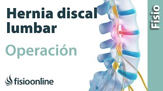 Hernia discal lumbar  Operación quirúrgica o cirugía [upl. by Nudd]