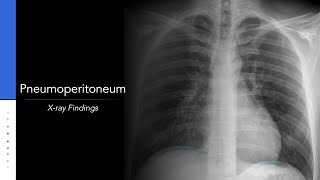 Pneumoperitoneum Explanation of Xray Findings [upl. by Gnuh]