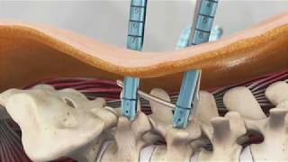 Palisade™ Pedicular Fixation System Animation [upl. by Bell]